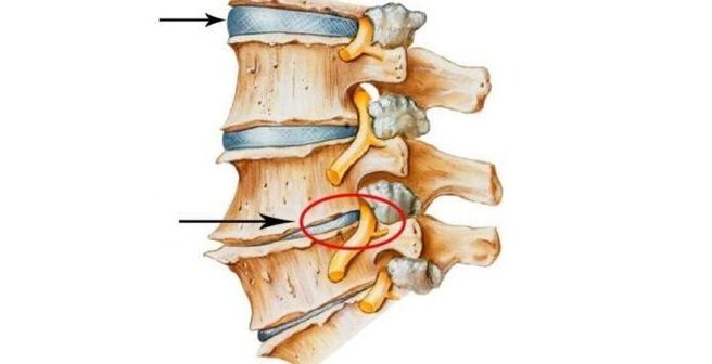 zdravý a poškodený chrbticový disk s cervikálnou osteochondrózou