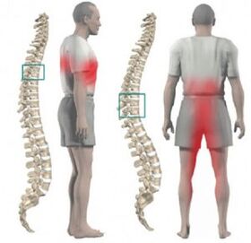 poškodenie chrbtice a bolesť pri hrudnej osteochondróze