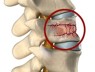 Príčiny bolesti chrbta môžu byť ochorenia chrbtice a medzistavcových platničiek. 