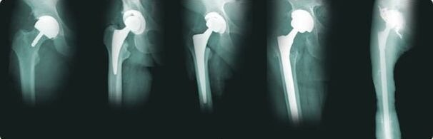 možnosti náhrady bedrového kĺbu pri artróze