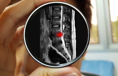 Dôsledkom ignorovania bolesti dolnej časti chrbta môže byť hernia disku. 