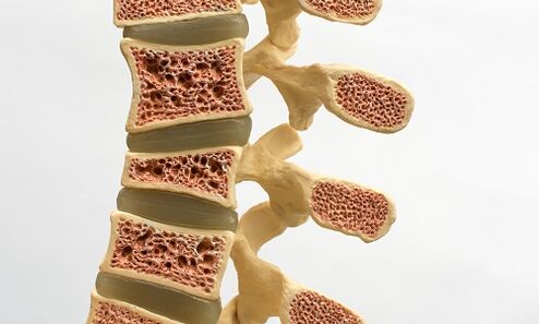 Osteoporóza je jednou z príčin bolesti dolnej časti chrbta