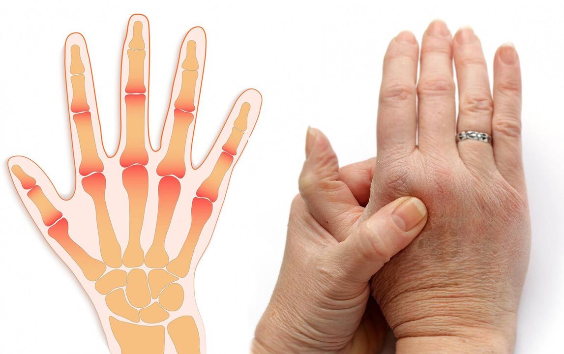 choroby prstov