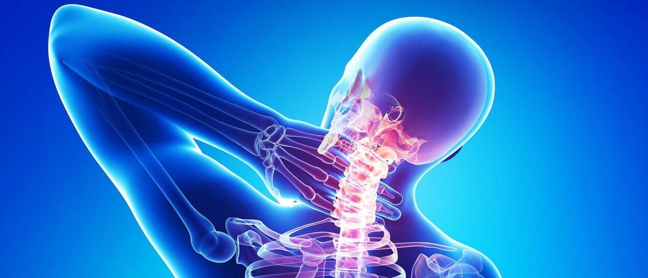 cervikálna osteochondróza je patologický proces v oblasti chrbtice