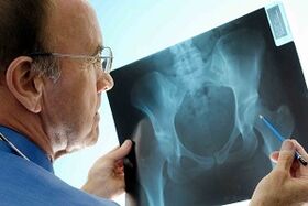 Artróza bedrového kĺbu na X -Ray