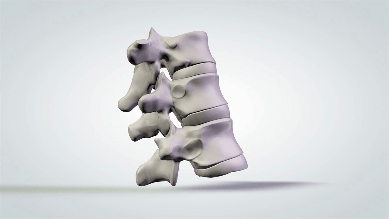 poškodenie chrbtice v dôsledku cervikálnej osteochondrózy