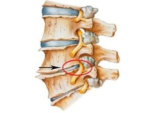 príznaky a symptómy osteochondrózy