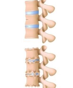 príčiny osteochondrózy
